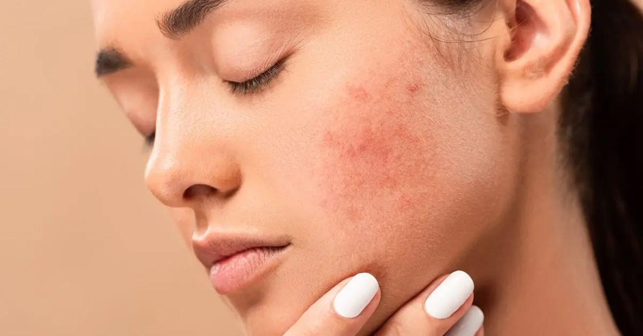 La meilleure façon de lutter contre les cicatrices d’acnés, utiliser ces 2 ingrédients recommandés par une dermatologue