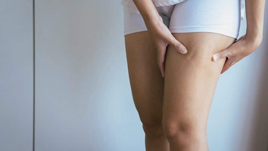 Cellulite