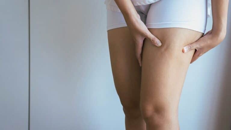 Cellulite