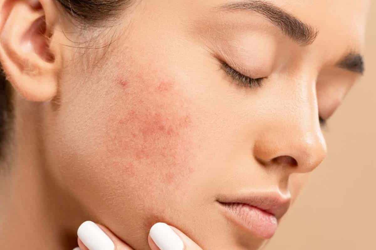 Beauté: comment se maquiller avec de l’acné? les conseils de cette dermatologue spécialisée
