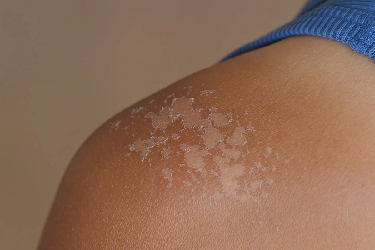 Comment combattre efficacement les taches blanches après un bronzage au soleil?